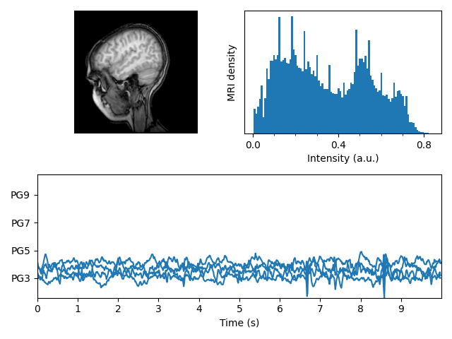 mri with eeg